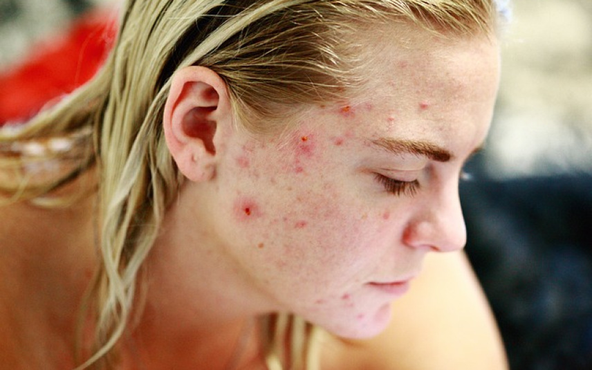 Traitement de l'acné : quels médicaments ? - Conseils santé ...