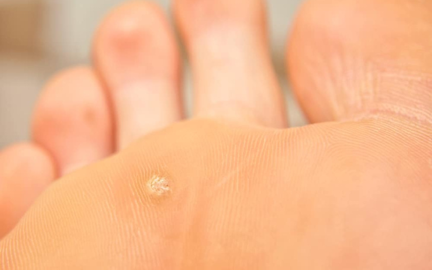 papillomavirus verrue pied