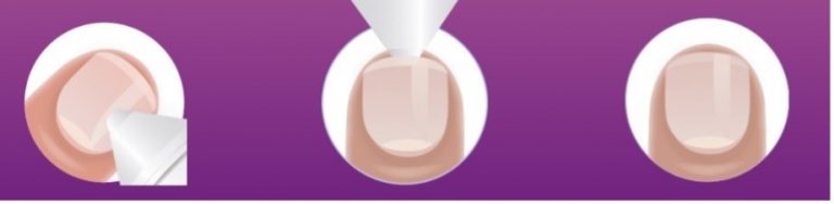 schéma d'application du stylo emtrix