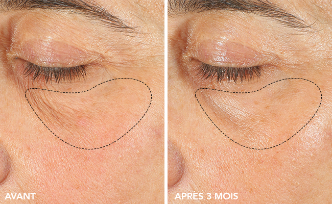 avant après utilisation du sérum absolu lierac sur les ridules du dessous de l'oeil