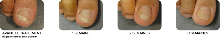 image avant et après le traitement emtrix